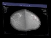 AI Can Now Clear Some Mammograms Without a Radiologist’s Review